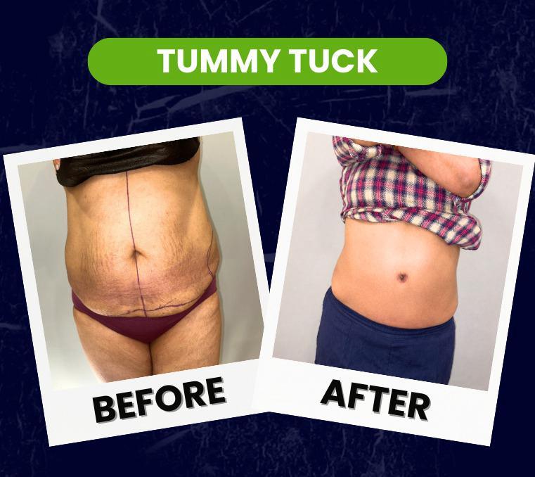 tummy tuck plastic surgery